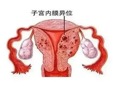 子宮內膜異位癥為什么會引發不孕？
