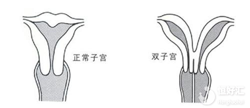 注意！子宮畸形正危及你的 “好孕”?！